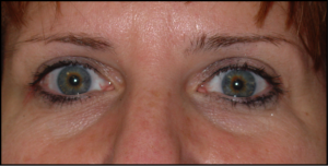 Tampa Eyelid and Orbital Surgery by Dr Kwitko 2