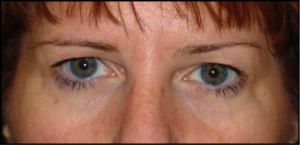 Tampa Eyelid and Orbital Surgery by Dr Kwitko