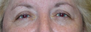 Pre Reconstructive Eyelid Surgery by Dr Kwitko