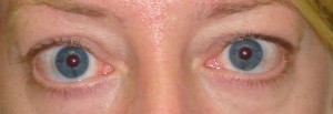 Pre Thyroid Eyelid Surgery by Dr Kwitko