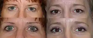 Cosmetic Eyelid Surgery Gallery