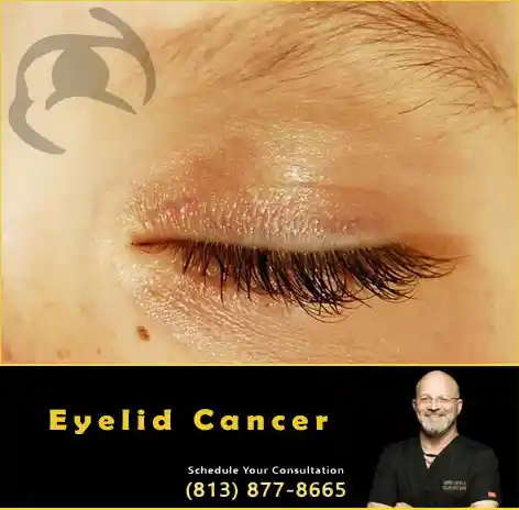 Dr Kwitko Eyelid Cancer Surgeon
