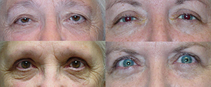 Tampa Eyelid and Orbital Surgery by Dr Kwitko