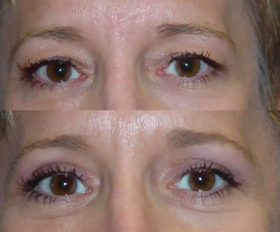 Cosmetic Eyelid Surgery